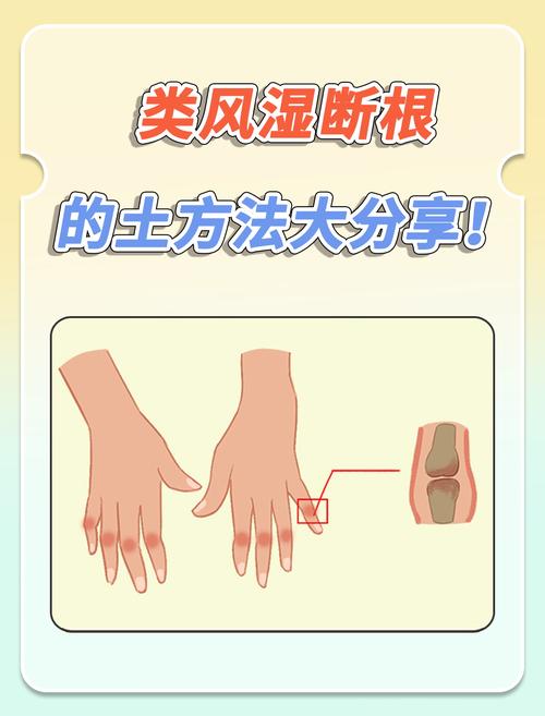 手脚风湿类风湿怎么治疗