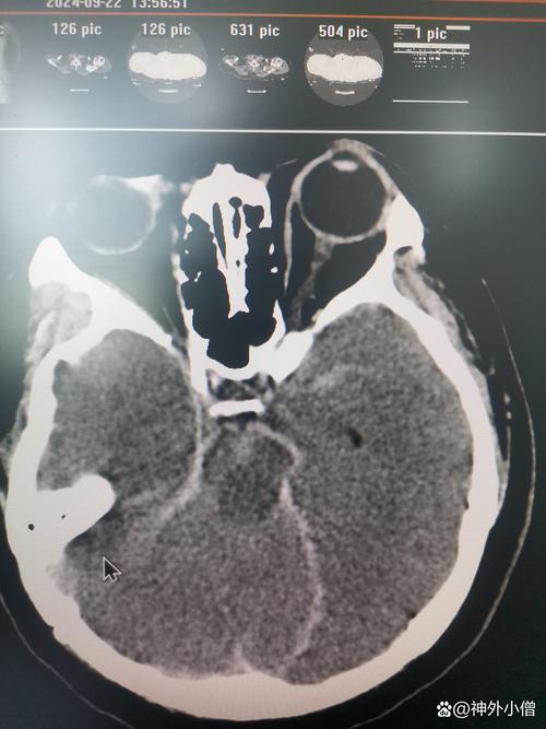 脑梗 术后 出血 ct
