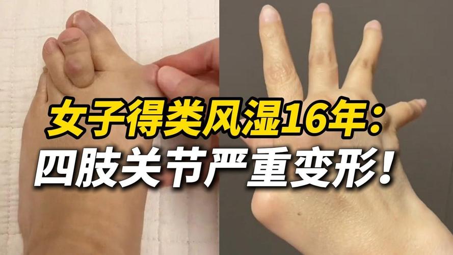 风湿类风湿那个地方最多