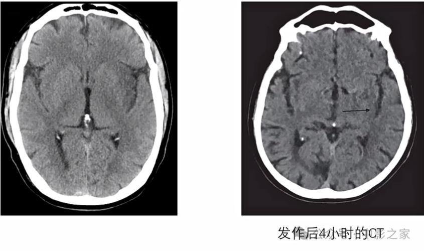 做脑ct查着有轻微脑梗