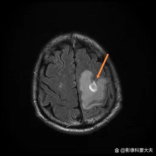 脑ct能基本排除脑梗么