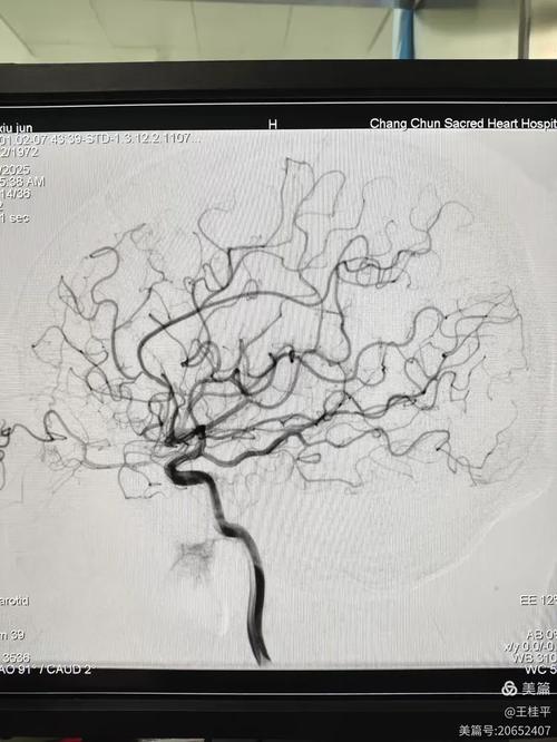 脑梗患者 检查 CTA