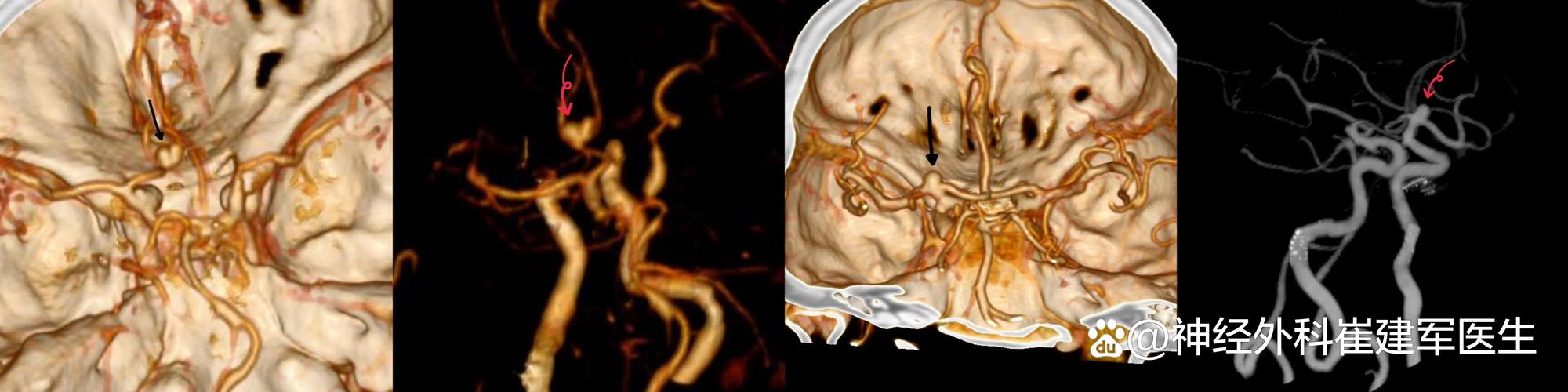 脑梗患者 检查 CTA