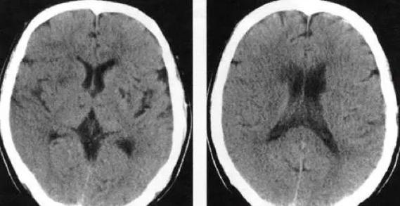 脑ct没事能排除脑梗吗