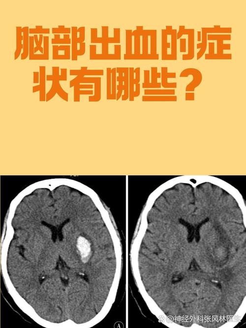 什么是脑淤血什么是脑梗