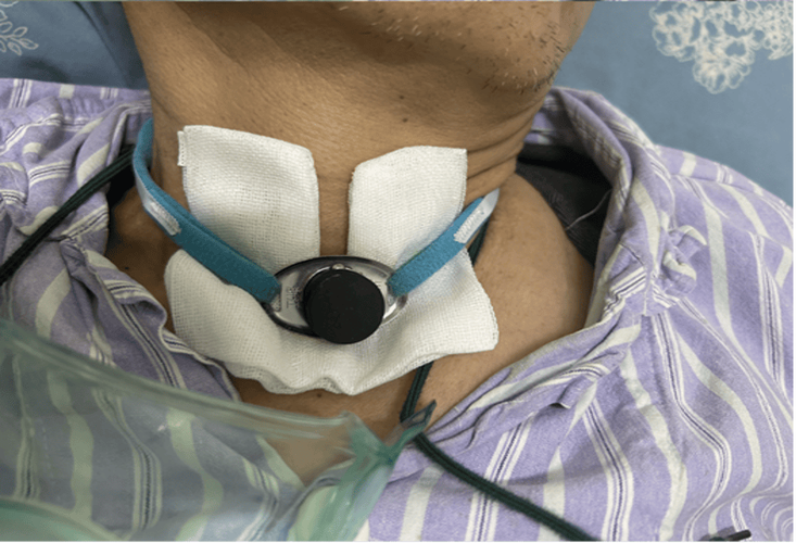 脑梗 icu 气管切开