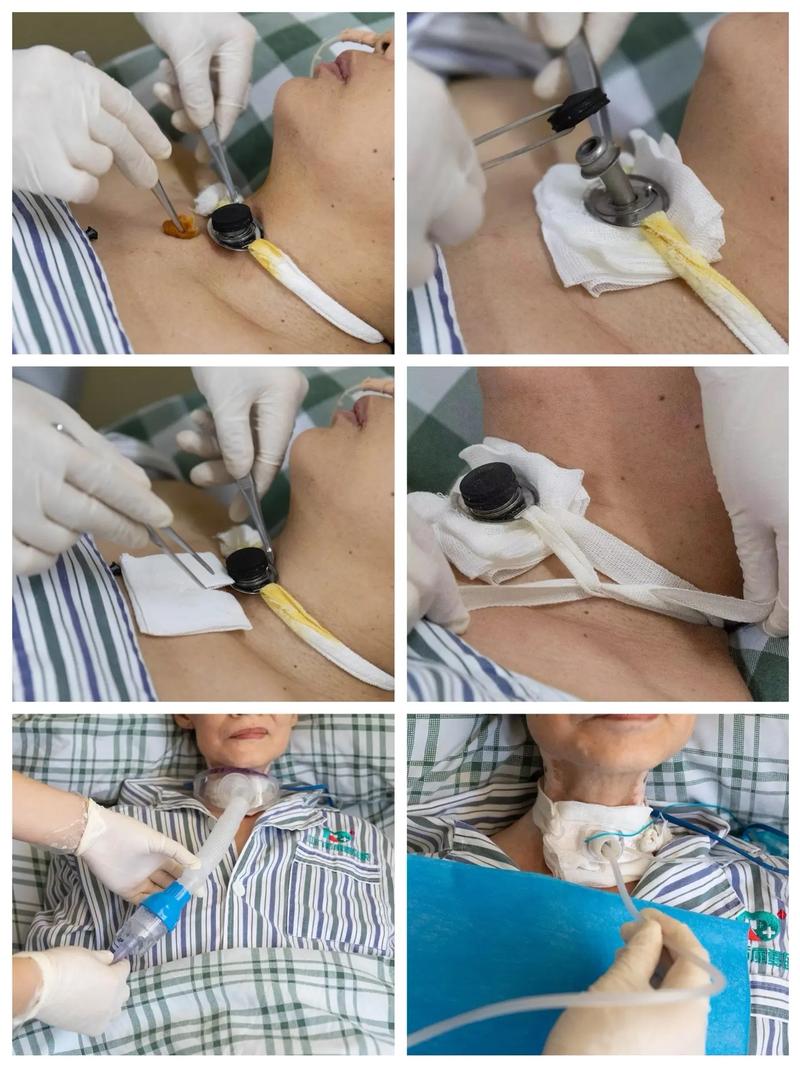 脑梗 icu 气管切开