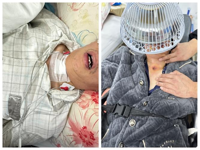 脑梗 icu 气管切开