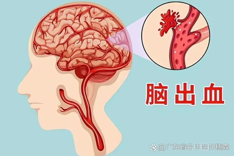 心源性 非心源性 脑梗