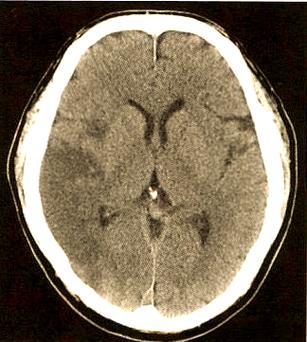 心源性 非心源性 脑梗