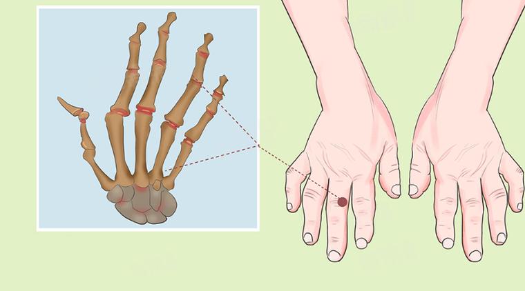 手指关节风湿类风湿土法