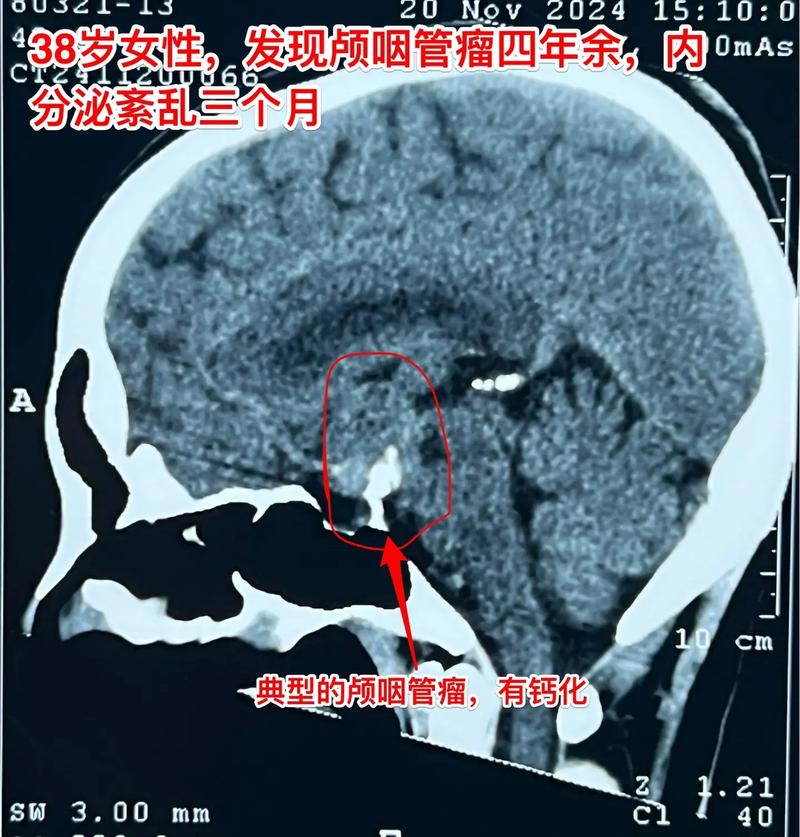 喉管 息肉 破裂 脑梗