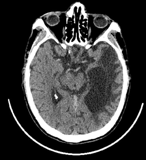 急性脑梗后形成脑软化灶