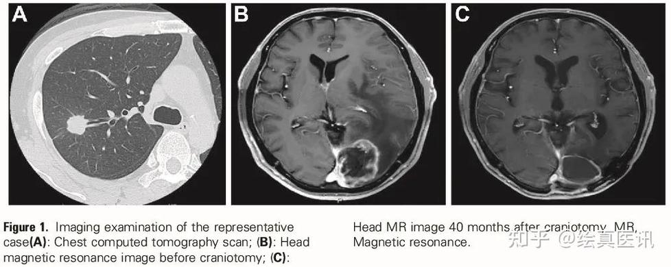 肺腺癌晚期脑转加上脑梗