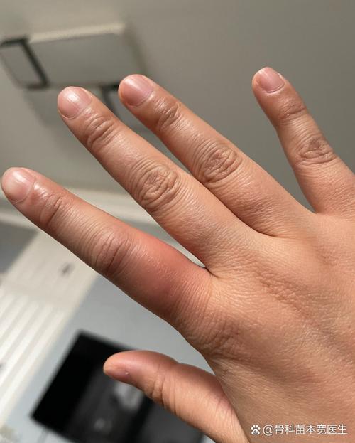 手指肿是风湿还是类风湿