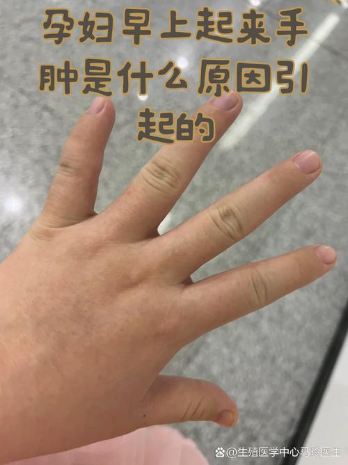 手指肿是风湿还是类风湿