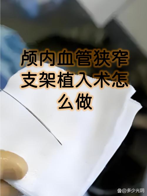 脑梗做脑造影需要买什么