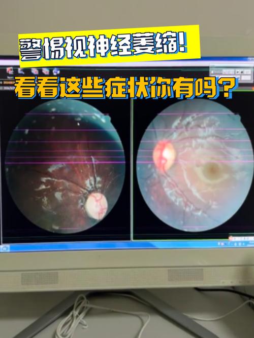 警惕 脑梗 眼睛 黑影