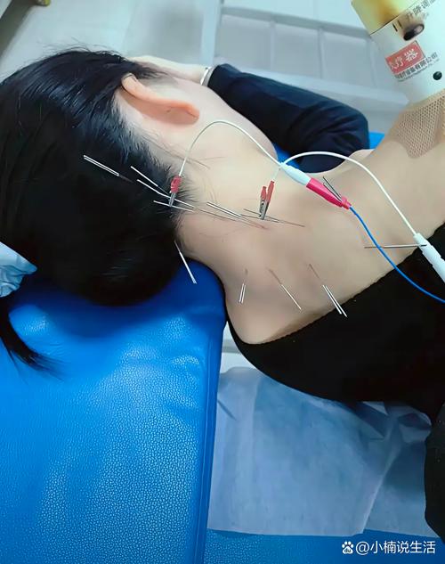 针灸美容穴位视频直播