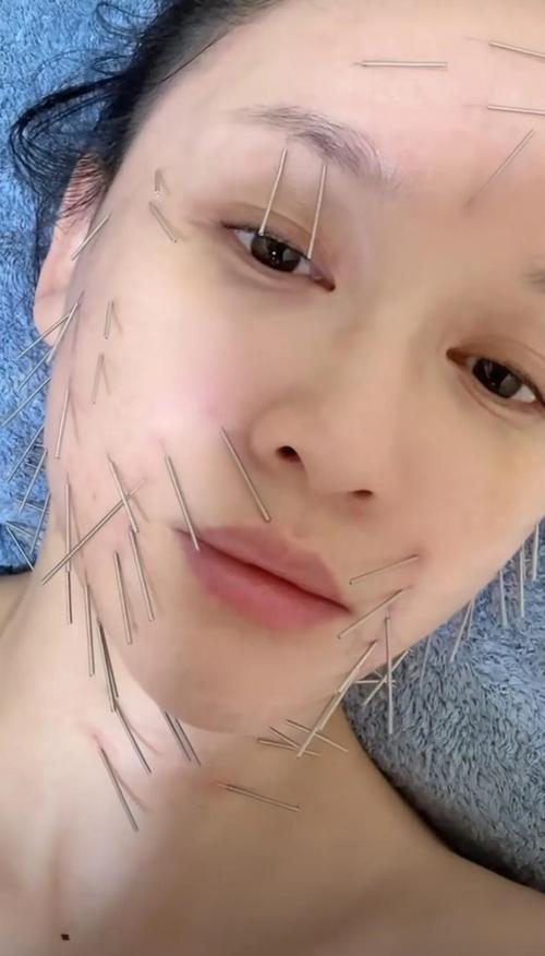 针灸美容穴位视频直播