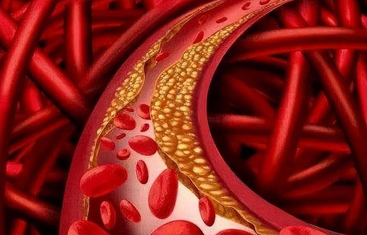 血栓性脑梗和缺血性脑梗