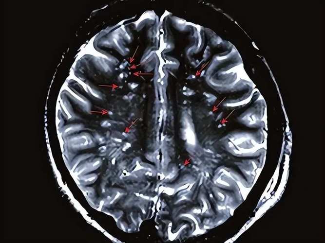 陈旧性脑梗和腔隙性脑梗