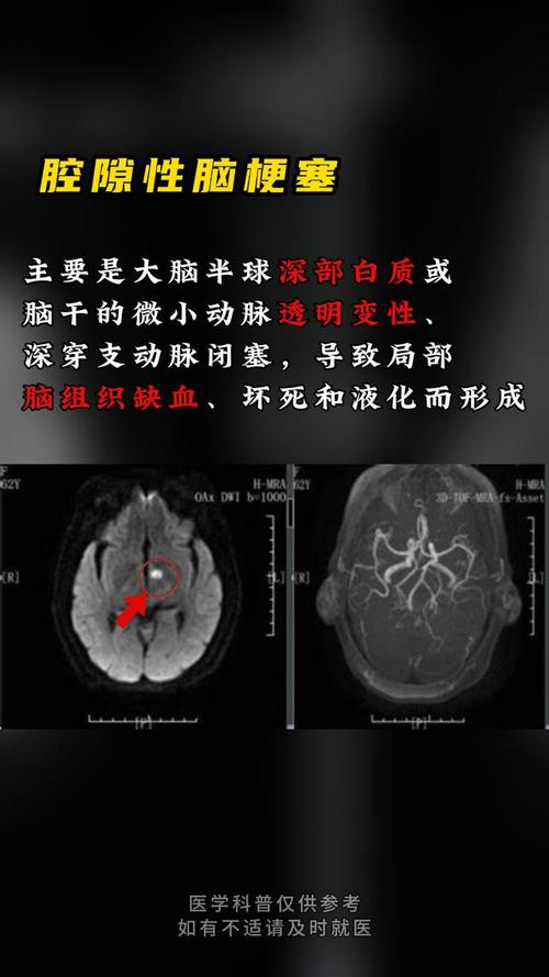 陈旧性脑梗和腔隙性脑梗