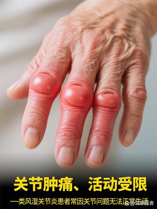 类风湿的早期类风湿医院