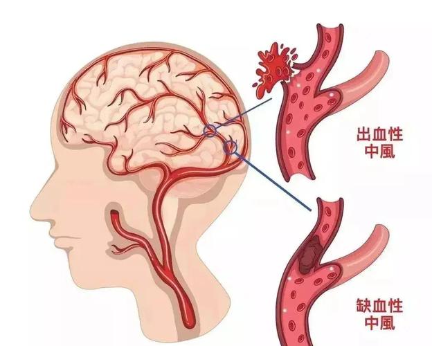 脑基底动脉脑梗持续高热