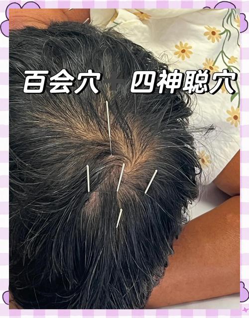 放松大脑按摩什么穴位