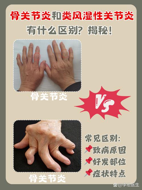 风湿和内风湿的症状区别