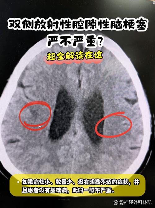 怎样看懂脑ct脑梗图片
