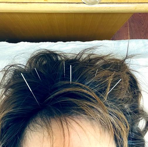 抑郁焦虑针灸什么穴位