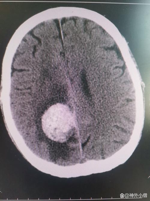 脑溢血 脑梗 心梗检测