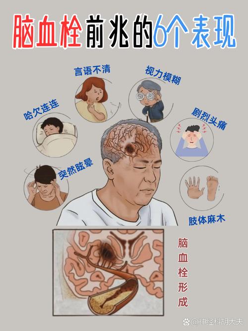 脑梗脑淤血堵塞什么症状