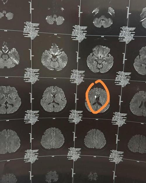 右边脑梗一年后左边脑梗