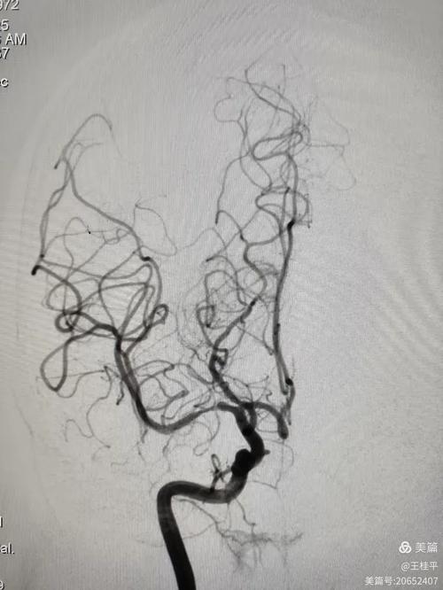 脑动脉狭窄还没引发脑梗