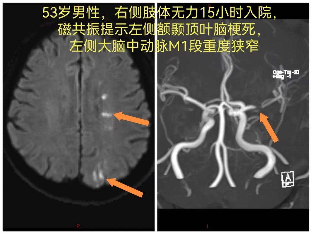 脑动脉狭窄还没引发脑梗