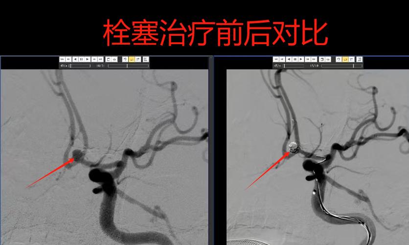 脑 动脉瘤 介入 脑梗