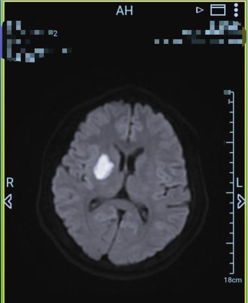 核磁共振 脑肿块 脑梗