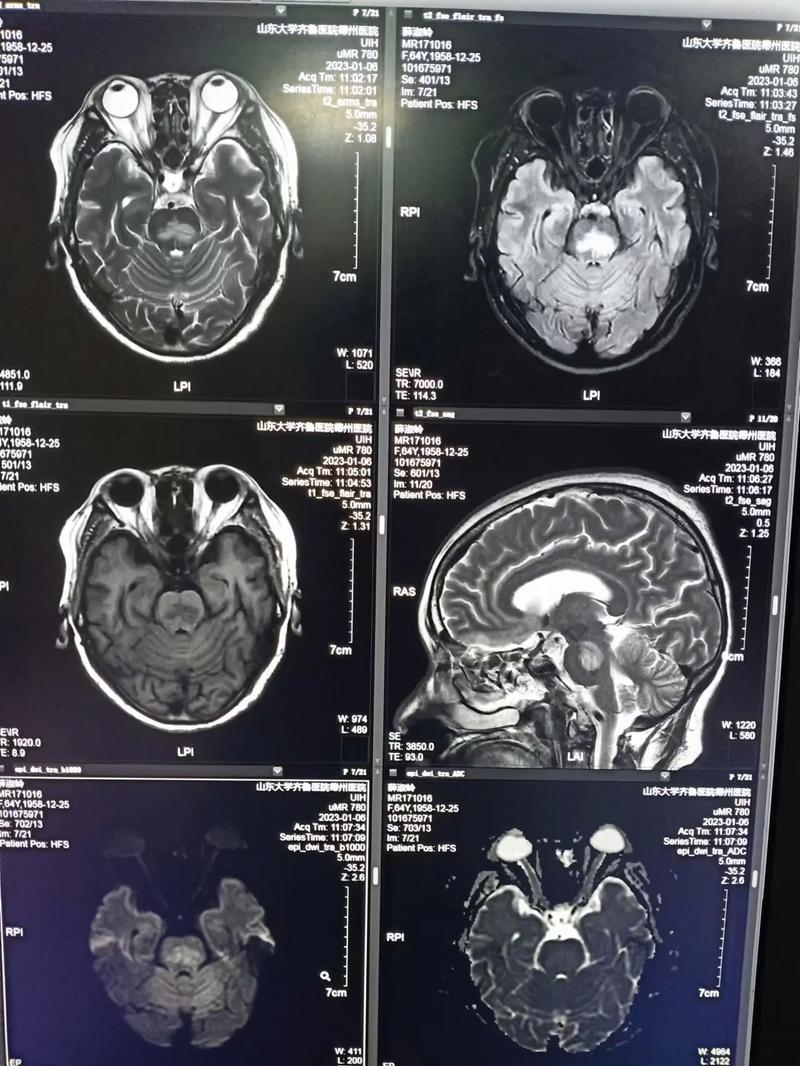脑ct 可以查出脑梗吗