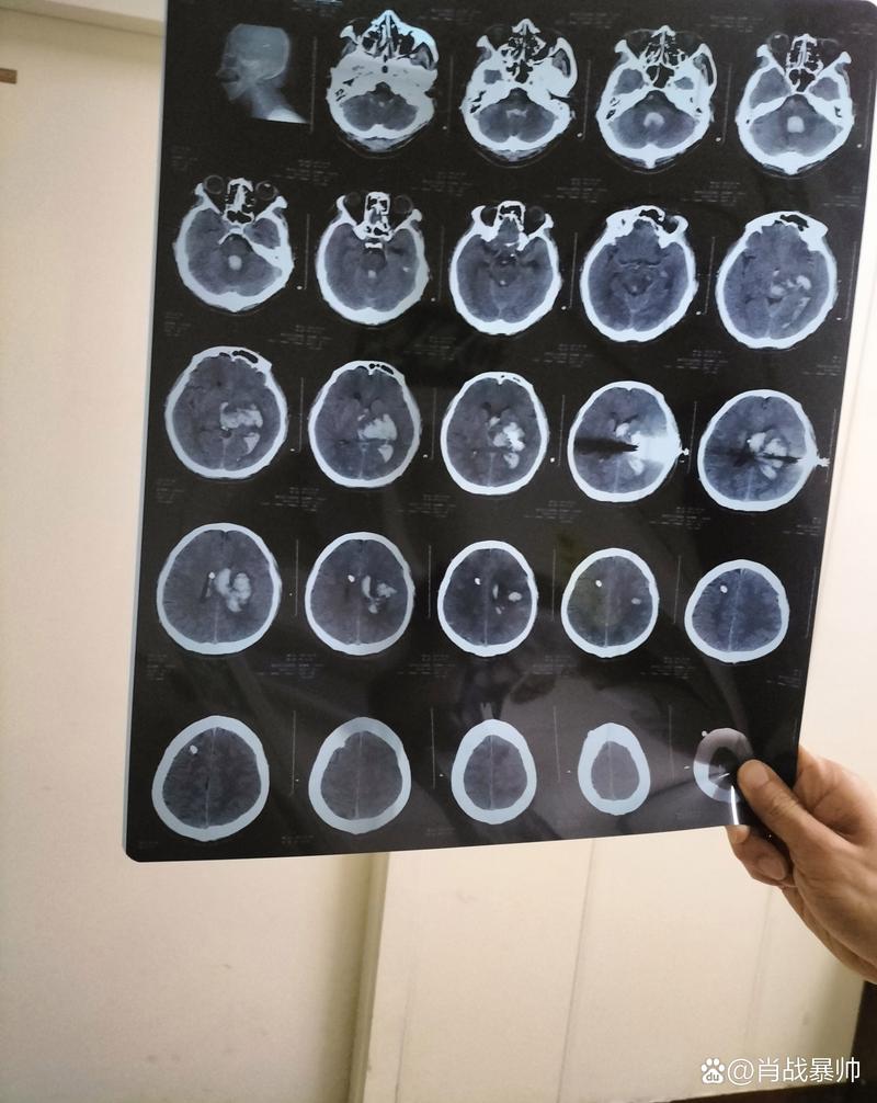 脑ct正常血压正常脑梗