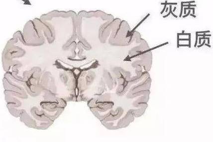 脑梗引起脑白质间质水肿