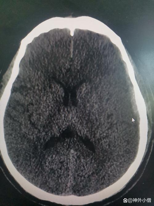 脑梗引起脑白质间质水肿