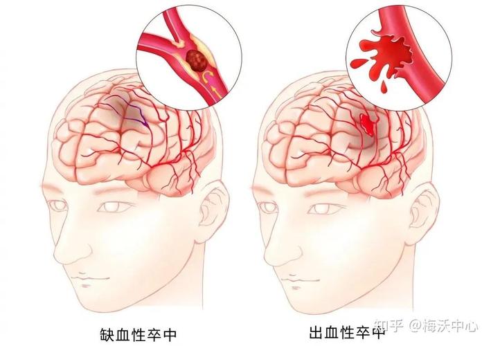 脑左边脑溢血脑右边脑梗
