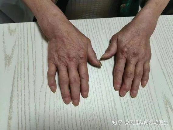 风湿类风湿免疫系统病灶