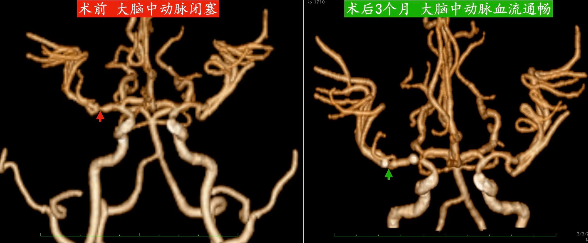 脑梗支架并不能根治脑梗