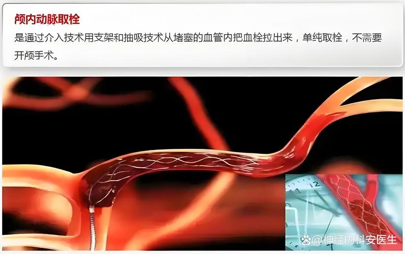 脑梗支架并不能根治脑梗