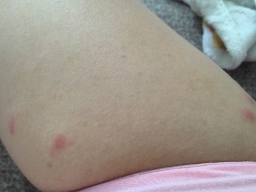 风湿疙瘩和风湿有关系吗