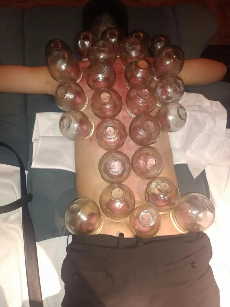 拔罐刮痧治疗风湿类风湿